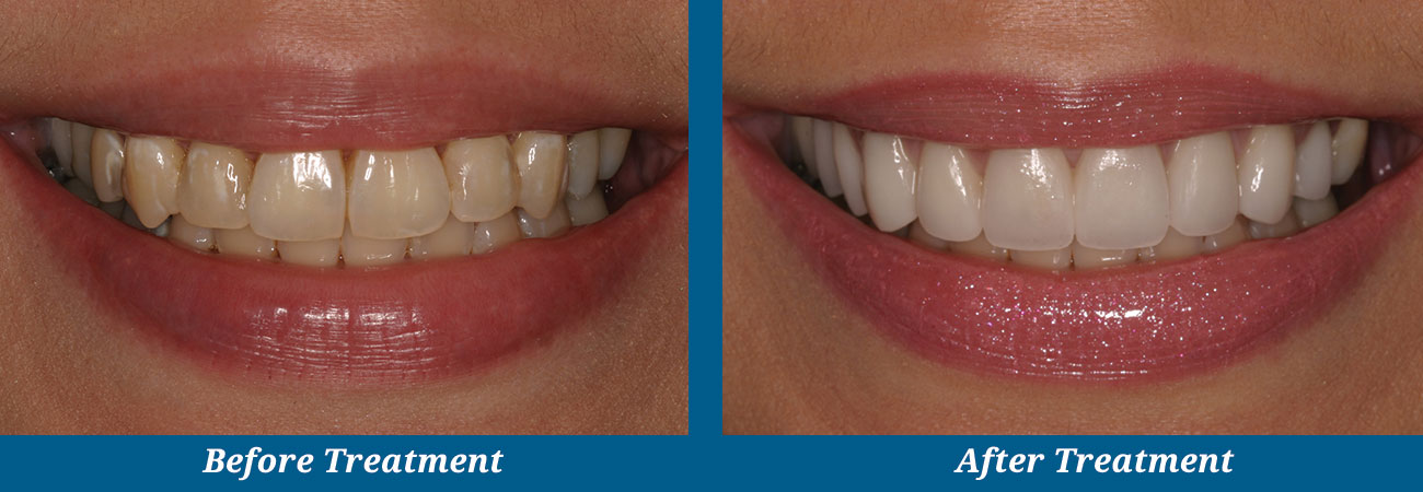 rockplazadental-before-after-1