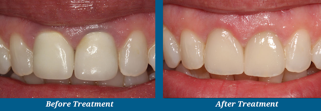 rockplazadental-before-after-11