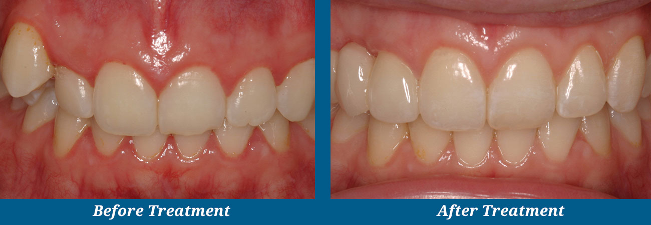 rockplazadental-before-after-14