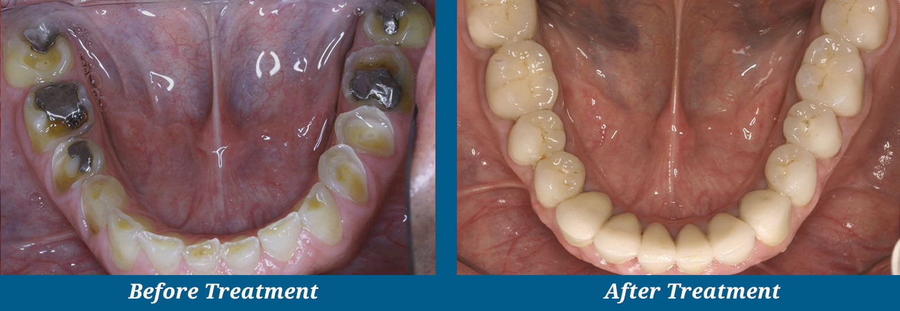 rockplazadental-before-after-18
