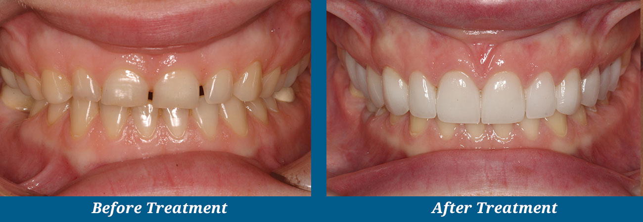 rockplazadental-before-after-2