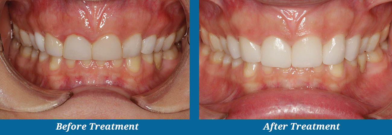 rockplazadental-before-after-24