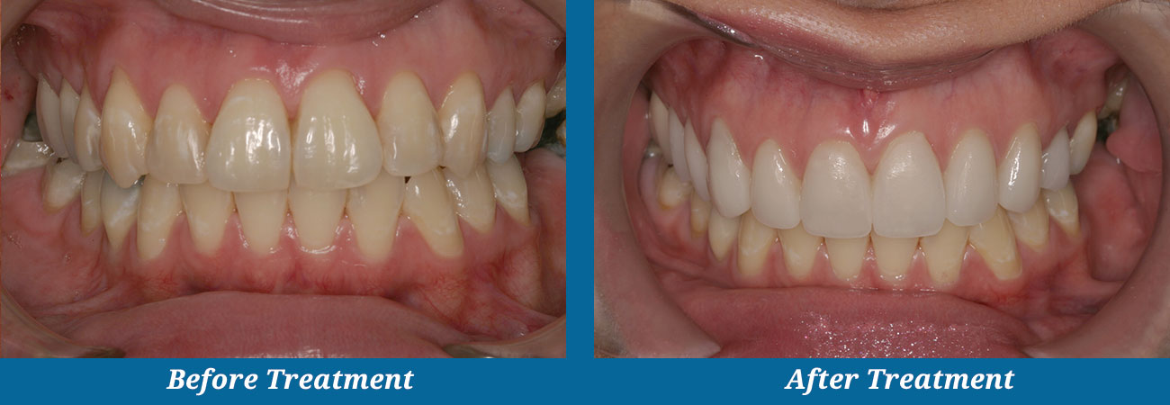 rockplazadental-before-after-26veneers