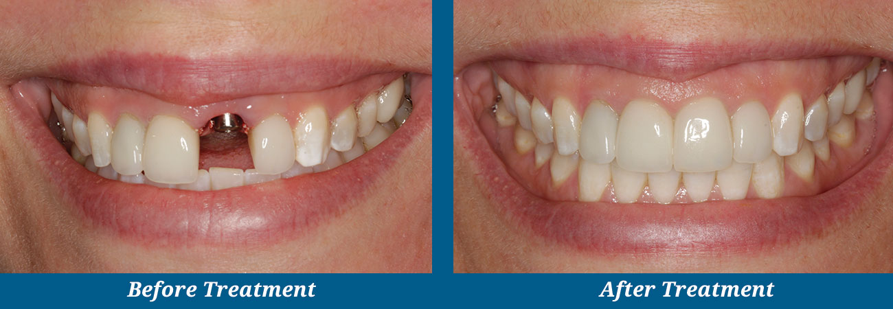 rockplazadental-before-after-6