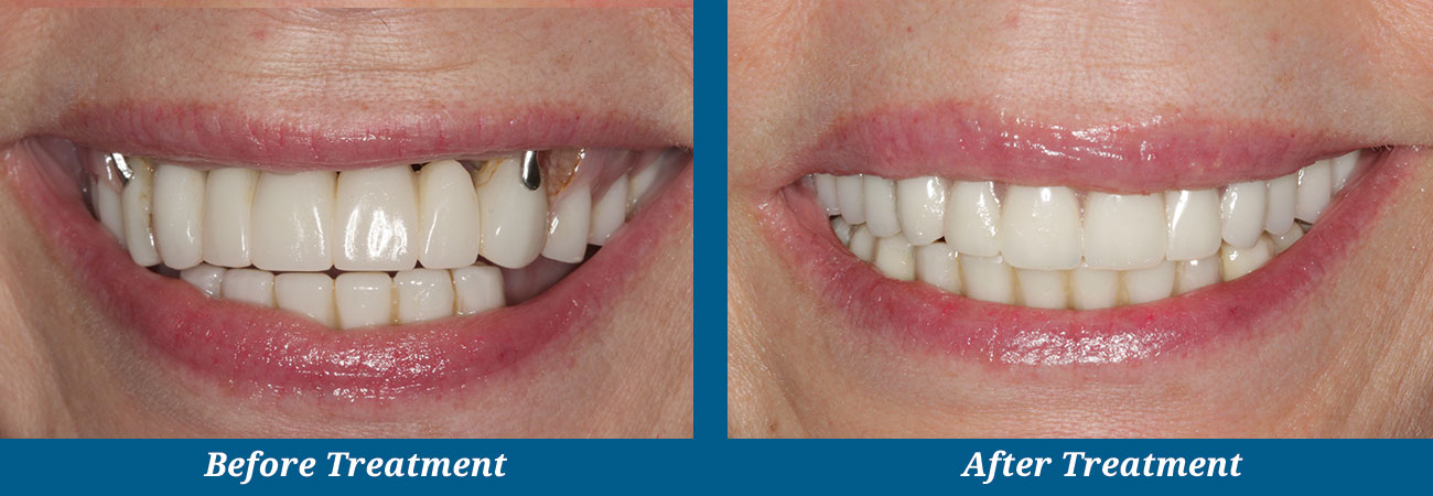 rockplazadental-before-after-7