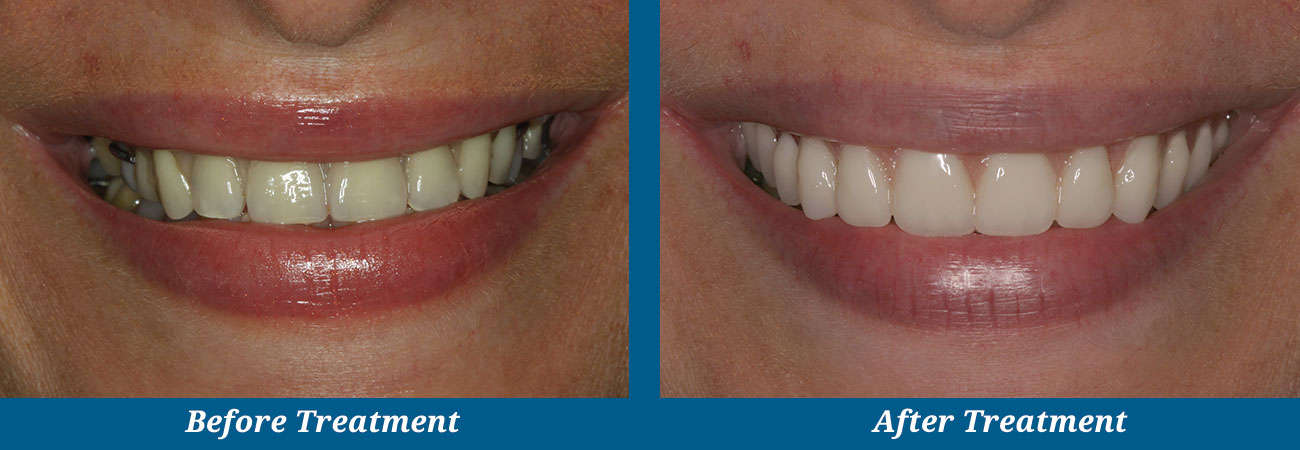 rockplazadental-before-after-8